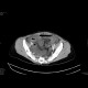 Multiple visceral thromboses of unknown etiology: CT - Computed tomography