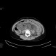 Multiple visceral thromboses of unknown etiology: CT - Computed tomography