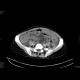 Multiple visceral thromboses of unknown etiology: CT - Computed tomography