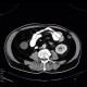 Mucocoele of appendix: CT - Computed tomography