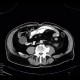 Mucocoele of appendix: CT - Computed tomography