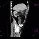 Mucocoele of appendix: CT - Computed tomography