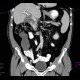 Mucocoele of appendix: CT - Computed tomography