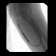 Shunt stenosis, angioplasty: AG - Angiography