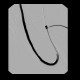 Shunt stenosis, angioplasty: AG - Angiography