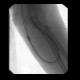 Shunt stenosis, angioplasty: AG - Angiography