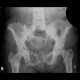 Osteosclerotic metastases of pelvis: X-ray - Plain radiograph