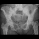 Osteosclerotic metastases of pelvis: X-ray - Plain radiograph