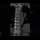 Skeletal changes in myeloma, thoracic spine and ribs: CT - Computed tomography