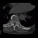 Skeletal changes in myeloma, thoracic spine and ribs: CT - Computed tomography