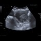 Fibroid of uterus, uterine fibroid: US - Ultrasound
