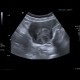 Fibroid of uterus, uterine fibroid: US - Ultrasound
