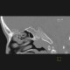 Nasopharyngeal tonsil, enlarged: CT - Computed tomography