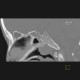 Nasopharyngeal tonsil, enlarged: CT - Computed tomography