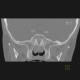 Nasopharyngeal tonsil, enlarged: CT - Computed tomography