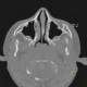Nasopharyngeal tonsil, enlarged: CT - Computed tomography
