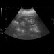 Nephrocalcinosis, calcification of papilla: US - Ultrasound