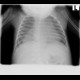 Neuroblastoma, mediastinal neuroblastoma: X-ray - Plain radiograph