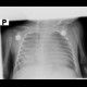 Neuroblastoma, mediastinal neuroblastoma: X-ray - Plain radiograph