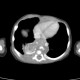 Neuroblastoma, mediastinal neuroblastoma: CT - Computed tomography
