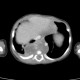 Neuroblastoma, mediastinal neuroblastoma: CT - Computed tomography