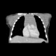Neuroblastoma, mediastinal neuroblastoma: CT - Computed tomography