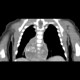 Neuroblastoma, mediastinal neuroblastoma: CT - Computed tomography