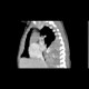 Neuroblastoma, mediastinal neuroblastoma: CT - Computed tomography
