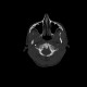 Atlas, C1, spina bifida, incomplete ring: CT - Computed tomography