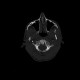 Atlas, C1, spina bifida, incomplete ring: CT - Computed tomography