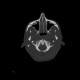 Atlas, C1, spina bifida, incomplete ring: CT - Computed tomography