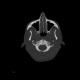 Atlas, C1, spina bifida, incomplete ring: CT - Computed tomography