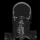 Atlas, C1, spina bifida, incomplete ring: CT - Computed tomography