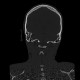 Atlas, C1, spina bifida, incomplete ring: CT - Computed tomography