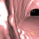 Polyp, diminutive lesion, ascending colon, CT colonography: CT - Computed tomography