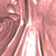 Polyp, diminutive lesion, ascending colon, CT colonography: CT - Computed tomography