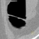 Polyp, diminutive lesion, ascending colon, CT colonography: CT - Computed tomography