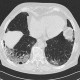 Non-specific interstitial pneumonia, NSIP, interstitial pneumonia: CT - Computed tomography