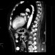 Thrombus in left ventricle, incidental finding: CT - Computed tomography