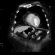 Thrombus in left ventricle, incidental finding: CT - Computed tomography