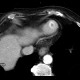 Thrombus in left ventricle, incidental finding: CT - Computed tomography