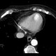 Thrombus in left ventricle, incidental finding: CT - Computed tomography