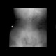 Nasojejunal tube, nasogastric tube: X-ray - Plain radiograph