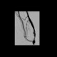 Shunt stenosis, angioplasty, native shunt: AG - Angiography