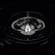 Necrosis of mesenteric fat, postoperative, colectomy: CT - Computed tomography