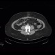 Necrosis of mesenteric fat, postoperative, colectomy: CT - Computed tomography
