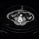 Necrosis of mesenteric fat, postoperative, colectomy: CT - Computed tomography