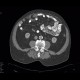 Unknown pathology, secondary finding, small bowel: CT - Computed tomography