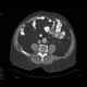 Unknown pathology, secondary finding, small bowel: CT - Computed tomography