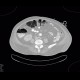 Layering of gas in the large bowel: CT - Computed tomography